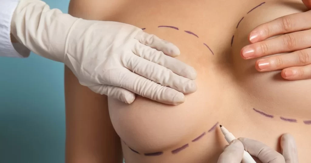 Breast Lift