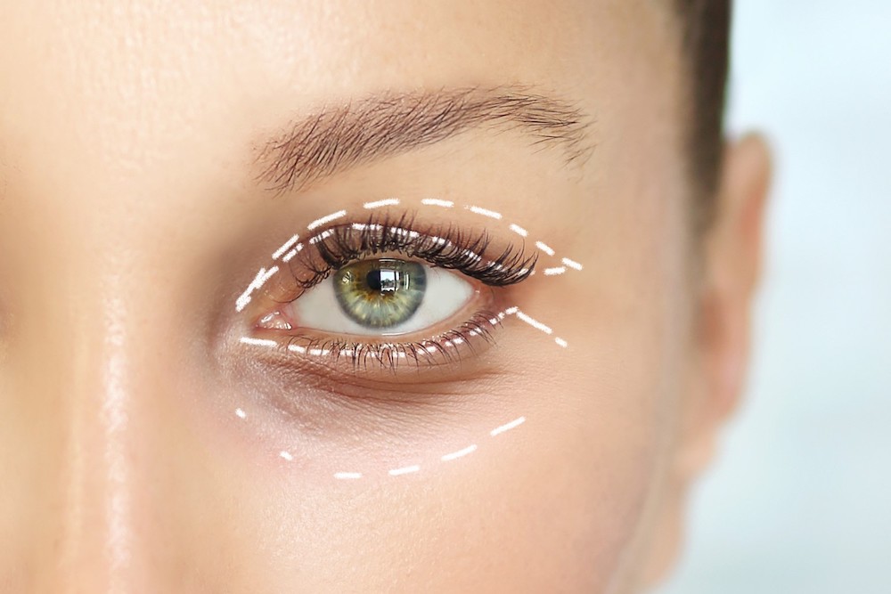 Blepharoplasty